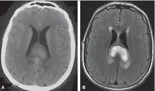 Figure 1. Non-contrast computed tomography (A) and T2-weighted fluid attenuated inversion recovery  mag-netic resonance imaging (B) demonstrating a large, heterogeneously enhancing mass in the splenium of the corpus callosum, consistent with a focal  colle