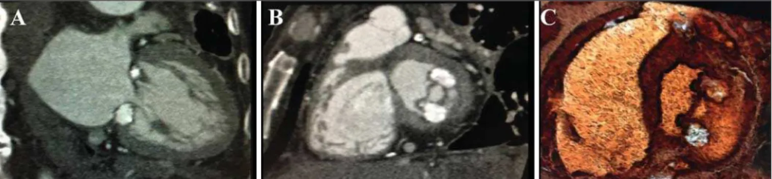 Figura 1. Degeneração caseosa da valva mitral. A: Eixo longo duas câmaras demonstrando as calcificações grosseiras do tipo caseosas entre as comissuras anterior e posterior