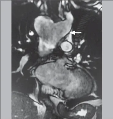Figure 2. Coronal T2-weighted spin-echo magnetic resonance imaging showing Kommerell’s diverticulum (arrow).