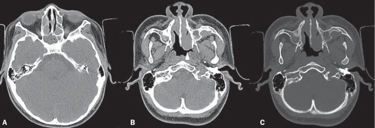 Figure 1. A: Axial CT section without contrast, showing opacification of the sphenoid sinuses and ethmoid cells by hypointense material