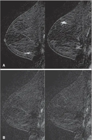 Figure 1. Patient presenting with synchronous areas of non-mass enhancement on sagittal T1-weighted post-contrast fat-saturated images after subtraction.