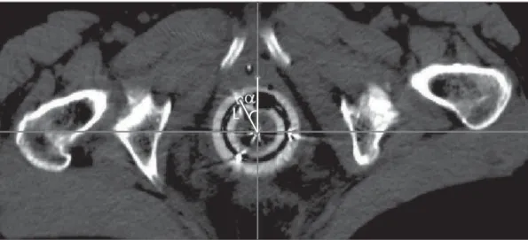 Figure 7. Axial section image showing the distance (L)  be-tween the first dwell position in the ring and the applicator  ori-gin, as well as the angle (α) between this distance and the axis perpendicular to the rectal retractor, when the image is aligned 