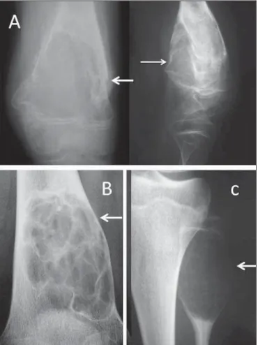 Figure 1. A: Conventional anteroposterior and lateral radiography of the left knee of a male schoolchild with knee pain