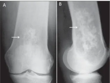 Figure 3. Conventional anteroposterior radiography (A) and conventional lateral radiography (B) of the left knee of a female patient with systemic lupus  erythema-tosus and joint pain