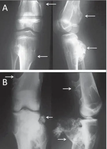 Figure 6. A previously asymptomatic young adult with a pain episode and acute limitation of right knee mobility after a common trauma