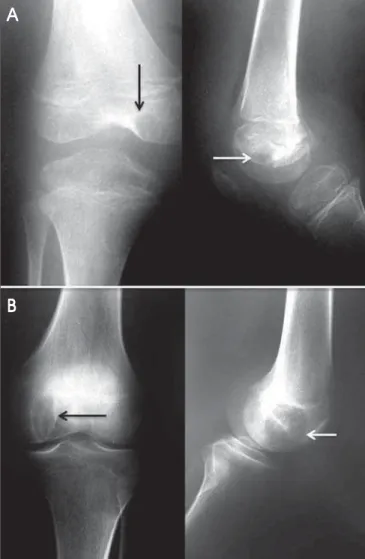Figure 8. A 14-year-old patient with progressive pain and localized swelling in the right knee
