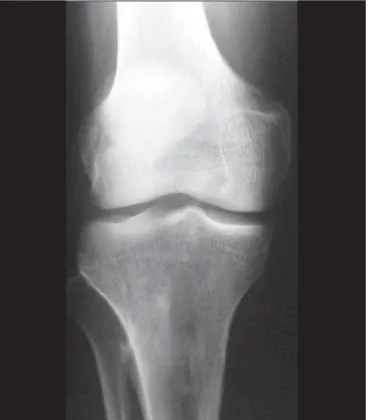 Figure 10. A 9-year-old male patient with pain and a large mass in the right thigh.