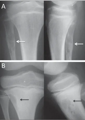 Figure 13. A: Anteroposterior and lateral radiography of the right knee of a fe- fe-male patient with a primary breast tumor