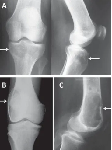 Figure 14. A: Adult female patient with recent knee pain; radiography shows an eccentric epiphyseal lytic lesion in the medial condyle of the tibia, without a  scle-rotic rim, with a narrow zone of transition, and without a periosteal reaction or invasion 