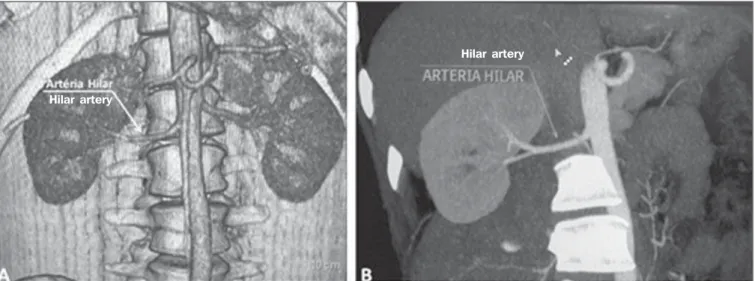 Figure 1. MDCT, frontal plane VR reconstruction (A) and coronal plane MIP reconstruction (B) showing the right hilar renal artery (arrow), which is a branch of the aorta that enters the kidney near the hilum and has terminal branches only at the hilum or r