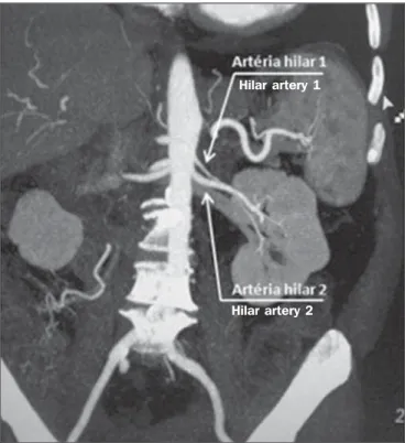 Figure 6. MDCT, coronal plane MIP reconstruction. Note the left main hilar artery (hilar artery 2) entering the hilum, as well as the left accessory hilar artery (hilar artery 1) that follows it