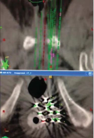 Figure 2. Planning computed tomography and reconstruction views in the axial and coronal planes.