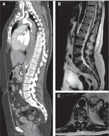 Figure 1. A: Maximum intensity projection reconstruction of computed tomogra- tomogra-phy angiogratomogra-phy in the sagittal plane showing an extensive mural thrombus in the thoracic aorta, extending to the infrarenal aorta