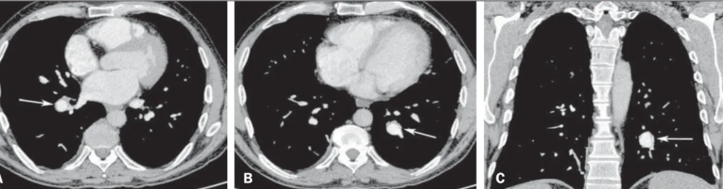 Figure 1. Contrast-enhanced computed tomography of the chest, with axial slices (A,B) and coronal slices (C), showing aneurysms in branches of the pulmonary arteries (arrows).
