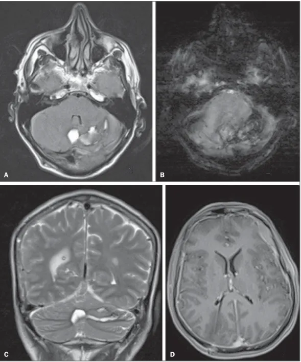 Figura 1. Imagens do exame de RM do crânio. A: Sequência FLAIR no plano axial mostra focos de hipersinal comprometendo o vermis e o hemisfério cerebelar esquerdo, compatíveis com hemorragia cerebelar