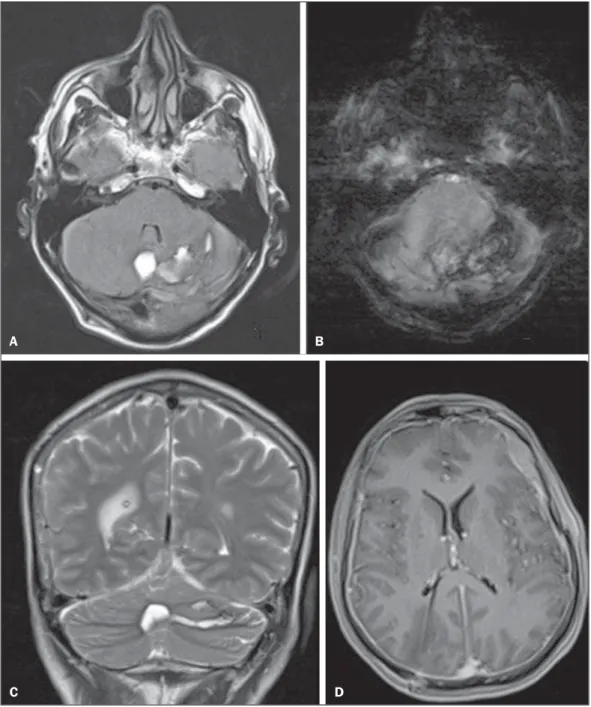 Figure 1. MRI scans of the cranium. A: FLAIR sequence in the axial plane, showing foci of hyperintense signals in the vermis and the left cerebellar hemisphere, which is consistent with cerebellar hemorrhage