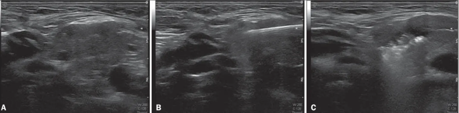 Figure 1. A: Normal right submandibular gland. B: Needle inserted into the gland. C: Botulinum toxin within the gland.