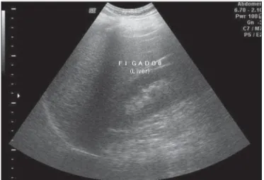 Figure 2. Liver steatosis grade 2. Liver parenchyma with increased echogenicity in relation to the renal cortex