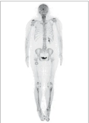 Figure 1. Example of VOIs drawn on three bone regions: proximal right humerus diaphysis; proximal right femoral diaphysis; and first vertebral body.