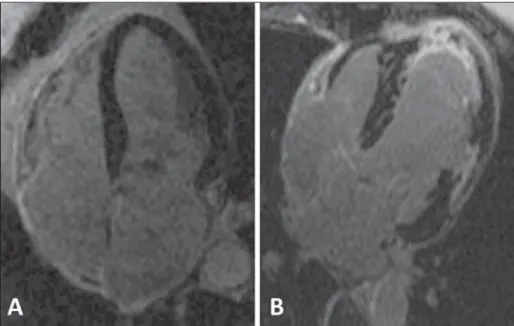Figure 3. Evaluation of delayed myocardial en- en-hancement. Normal study, black muscle (A)