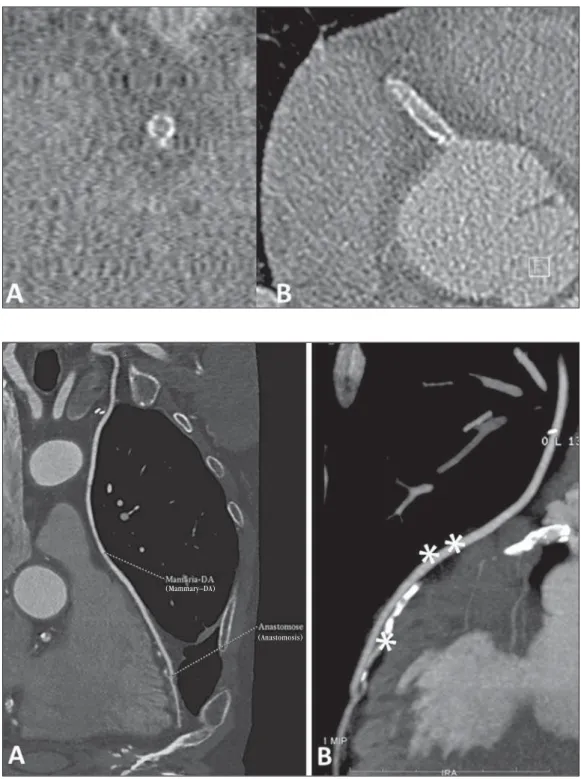 Figure 6. Evaluation of neointimal hyperplasia with intra-stent restenosis.