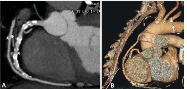 Figure 8. Evaluation of vena saphena graft to right  coro-nary artery. Note the  perme-able graft (double asterisks) and the anastomosis with the right coronary artery (single asterisk) (A)