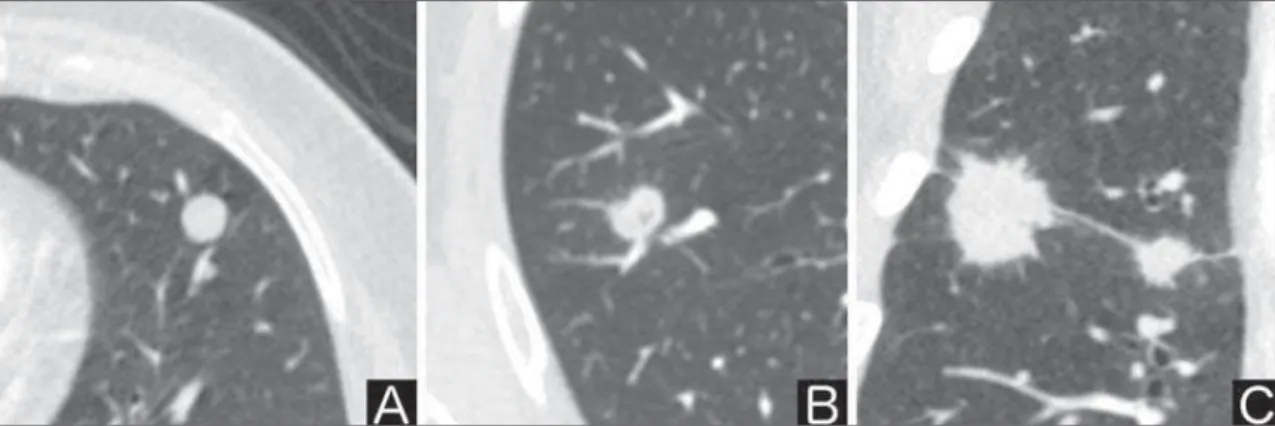 Figure 2. Benign calcification pattern. Chest CT – lung and bone windows. A,B:
