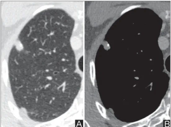 Figure 4. Fat. Presence of intranodular fat in hamartoma. Chest CT – mediastinal  win-dow (A,B)