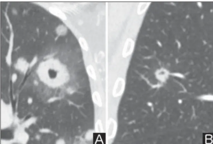 Figure 5. Attenuation. Chest CT – lung window. A: Solid. B: Partially solid. C: Non solid.