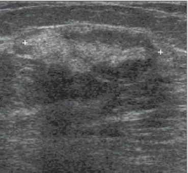 Figure 1. Simple adenosis. Ultrasonography showing hyperechoic, ovoid nodule with circumscribed margins and largest axis parallel to the skin.