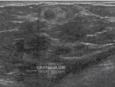 Figure 13. Metastasis from leiomyosarcoma. Ultrasonography identifying hetero- hetero-geneous, palpable nodule with microlobulated margins.