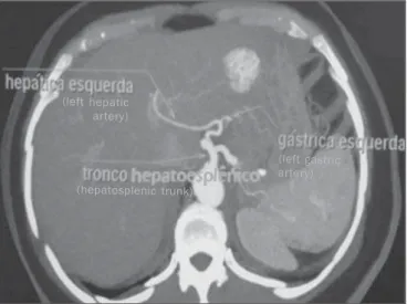Figure 4. Contrast-enhanced axial computed tomography showing a splenogastic trunk (consisting of splenic artery and left gastric artery – indicated by the arrow).