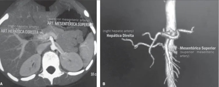 Figure 7. The image presents a case of right hepatic artery relocation, where it emerges from the superior mesenteric artery (Hiatt’s type III)