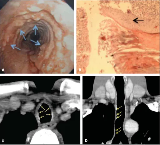 Figure 1. A: Laryngotracheobronchoscopy: