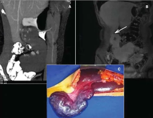 Figure 1. A: Contrast-enhanced total abdominal CT (oral and intravenous contrast-enhancement), sagittal section, venous phase showing a well defined mass in the right hypochondrium/flank in continuity with the liver, presenting with a pattern of peripheral