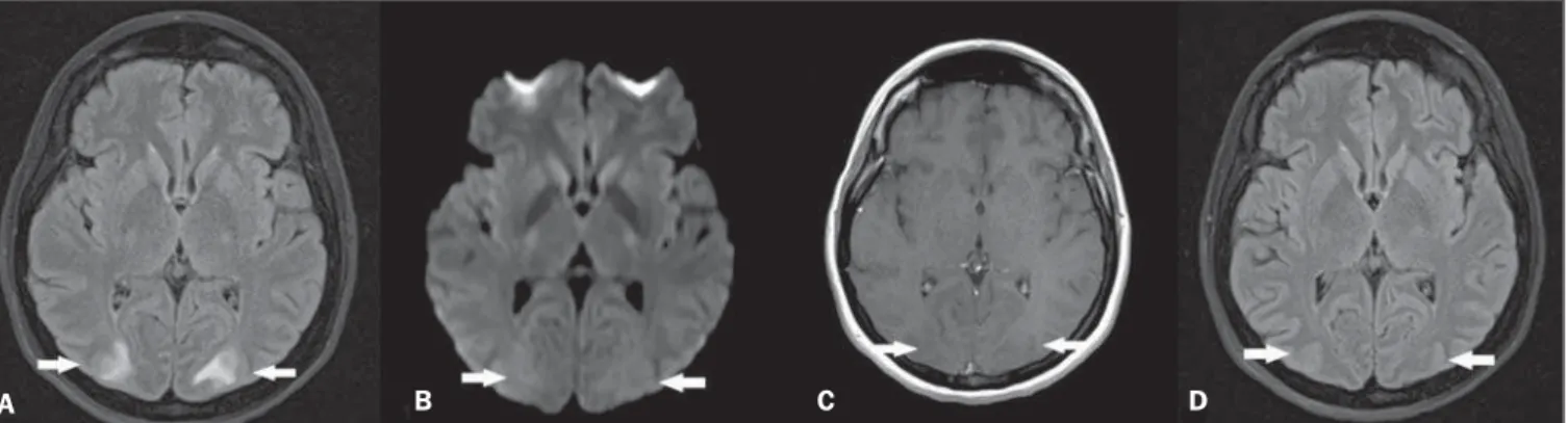 Figure 1. A: Axial MRI FLAIR sequence demonstrating hyperintensity in the occipital lobes white substance bilaterally and symmetrically (arrows)