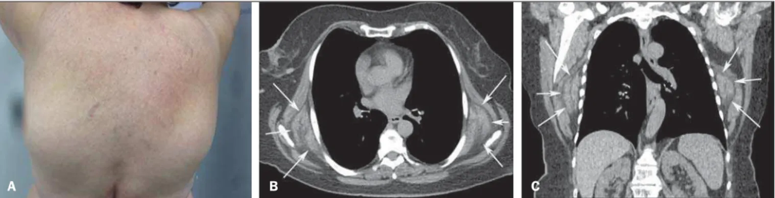 Figura 1. A: Fotografia da região dorsal da paciente mostrando o aspecto de tumores infraescapulares
