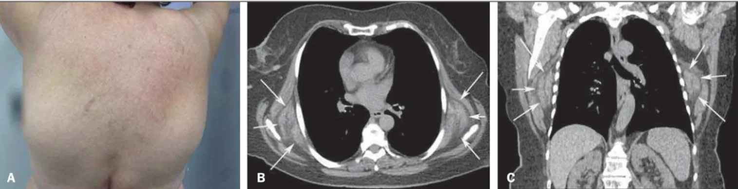 Figure 1. A: Photo of the patient’s dorsal region showing the appearance of infrascapular tumors