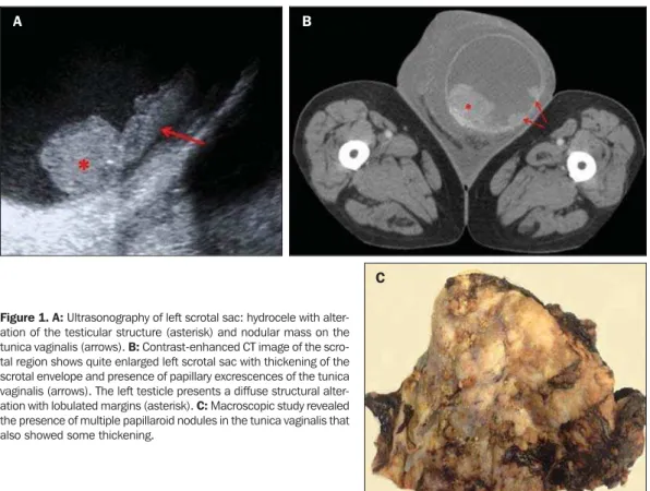 Figure 1. A: Ultrasonography of left scrotal sac: hydrocele with alter- alter-ation of the testicular structure (asterisk) and nodular mass on the tunica vaginalis (arrows)