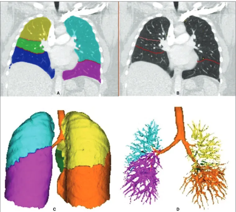 Figura 2.  Reconstruções ilustrativas da segmentação pulmonar automatizada realizada pelo programa automático Yacta