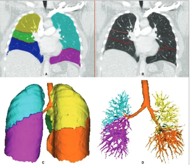 Figure 2. Illustrative reconstructions of the automated pulmonary segmentation performed by the Yacta automated program