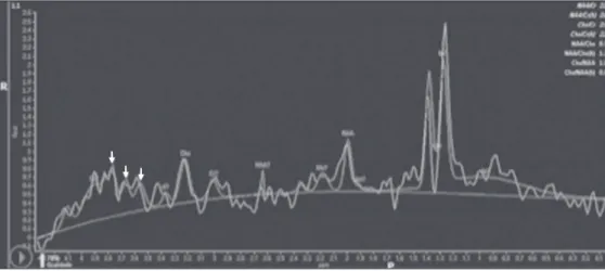 Figure 7.  Case 19. Proton magnetic  resonance  spectroscopy  of  the  core  of the lesion tissue showing a lactate  peak at 1.3 ppm and multiple signals  in the region of 3.6–3.8 ppm (arrows)  corresponding to trehalose.