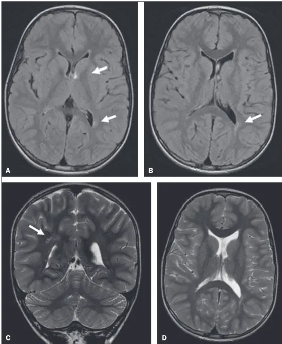 Figure 2. MRI of the brain showing ven- ven-tricular asymmetry (left lateral ventricle  greater than right) and  periventricu-lar foci of gliosis (arrows)
