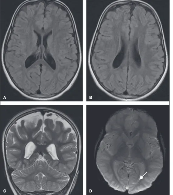 Figure 3. MRI of the brain showing  symmetric ventricular dilatation and  periventricular focus of hemoglobin  degradation (arrow)