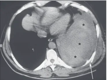 Figure 5. A 22-year-old male gunshot victim. Axial CT scan of the chest showing  left anterior pneumothorax (arrowheads), with foci of contusion at the  periph-ery of the ipsilateral lung (arrows) and small pleural effusion (asterisk).