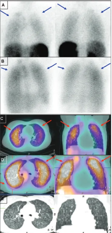 Figure 1. Static lung images (A,B) and transaxial SPECT/CT images (C,D)  with  99m Tc-EDDA-HYNIC-TOC (A,C) and  67 Ga citrate (B,D) of an 18-year-old  pa-tient with miliary tuberculosis, plus the CT imaging (E) performed for the scan  (2-slice CT, obtained