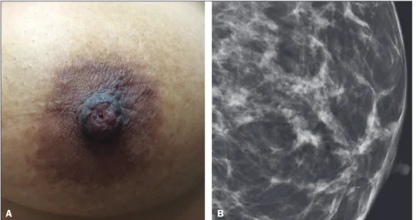 Figure 1. A: Photograph of the  nipple-areola complex in a  pa-tient with grade II DCIS that is  solid, cribriform, and necrotic,  with unilateral bloody nipple  discharge