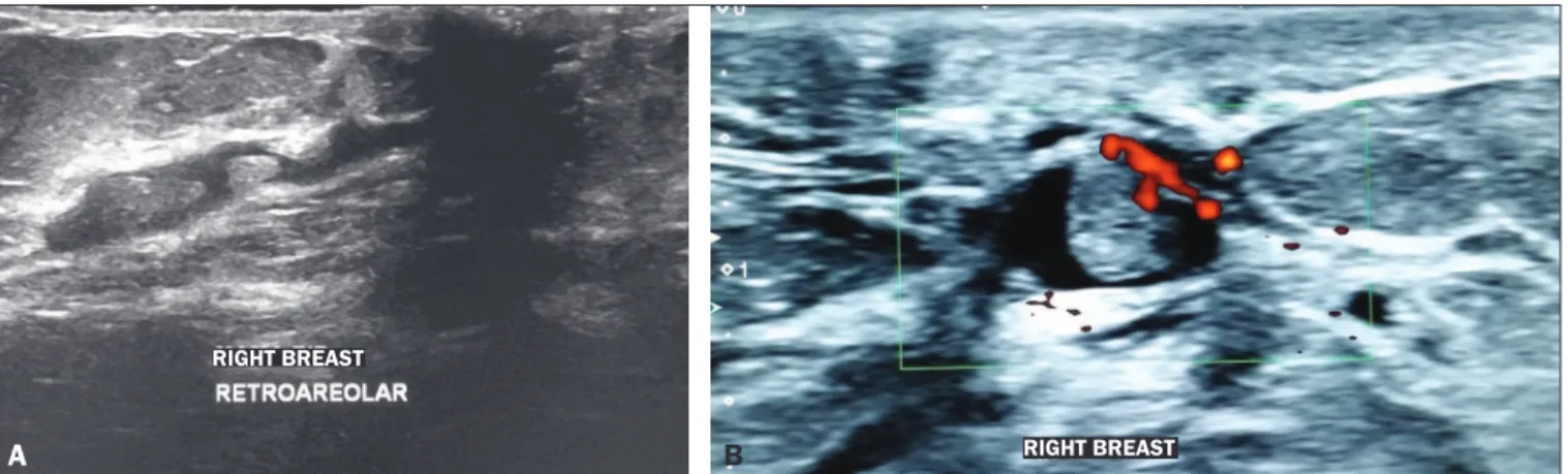 Figure 2. A: Ultrasound showing intraductal nodules. B: Doppler ultrasound showing vascularity within an intraductal nodule.