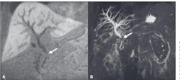 Figura 6.  Pós-operatório de hepatectomia com anastomose biliodigestiva. CHBE mostrou atraso na contrastação do lobo caudado ( A  – seta), sugerindo obstrução  severa ( B  – seta), antes mesmo de haver dilatação signiicativa da árvore biliar