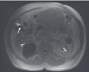 Figure 4.  Case of choledocholithiasis. An HSCA-enhanced MRC scan shows a  lack of contrast uptake within the gallbladder (arrow).